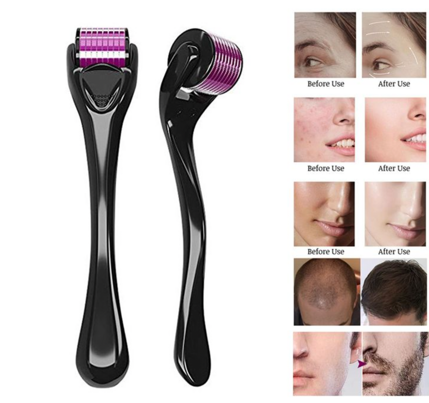 Derma Roller | Micro Needling Treatment