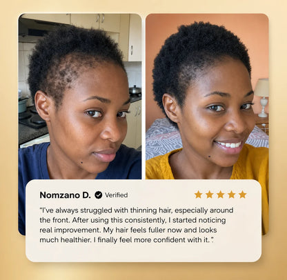 Minoxidil Hair growth Solution™