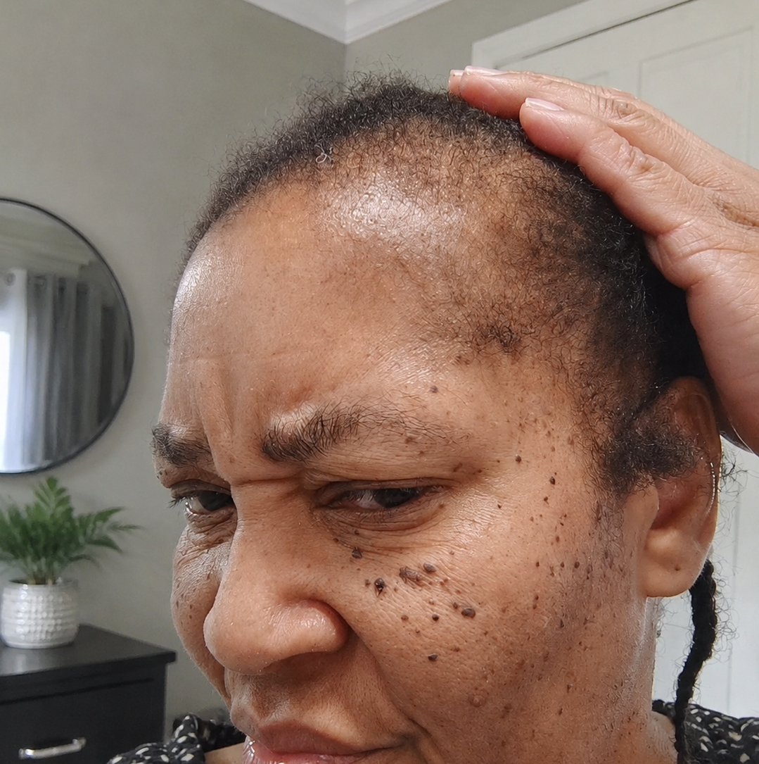 Minoxidil Hair growth Solution™
