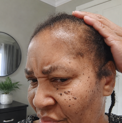 Minoxidil Hair growth Solution™